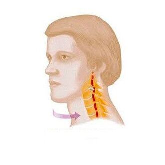 រោគសញ្ញានៃឆ្អឹងកងខ្នងដែលមានជំងឺ osteochondrosis មាត់ស្បូន