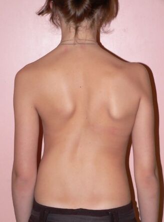 Scoliosis 2 ដឺក្រេ