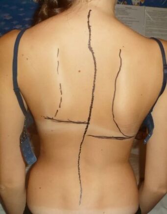 ឆ្អឹងជំនី hump