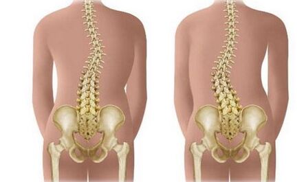 ជំងឺ Scoliosis មិនស្ថិតស្ថេរ
