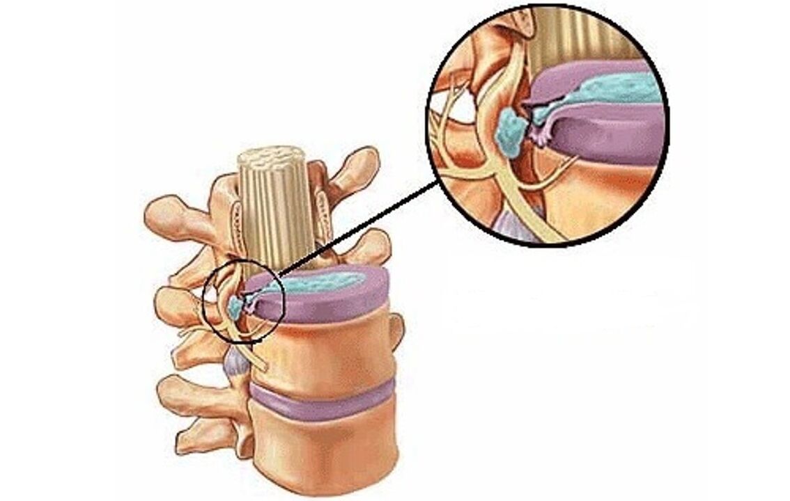 ក្លនលូន intervertebral ជាមួយ osteochondrosis thoracic