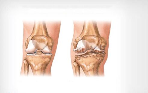 arthrosis នៃសន្លាក់ជង្គង់