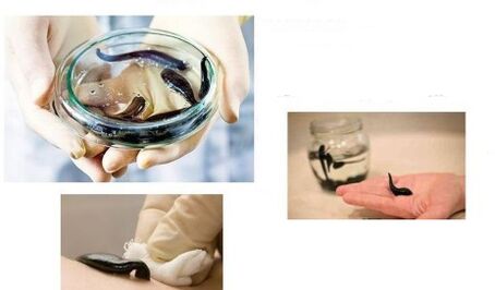 ការព្យាបាលដោយ hirudo សម្រាប់ arthrosis